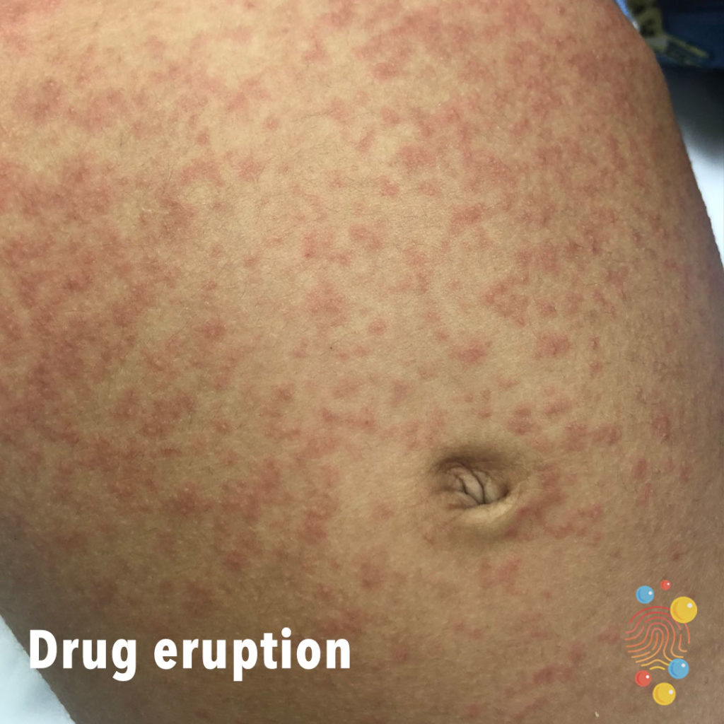 Drug Eruption