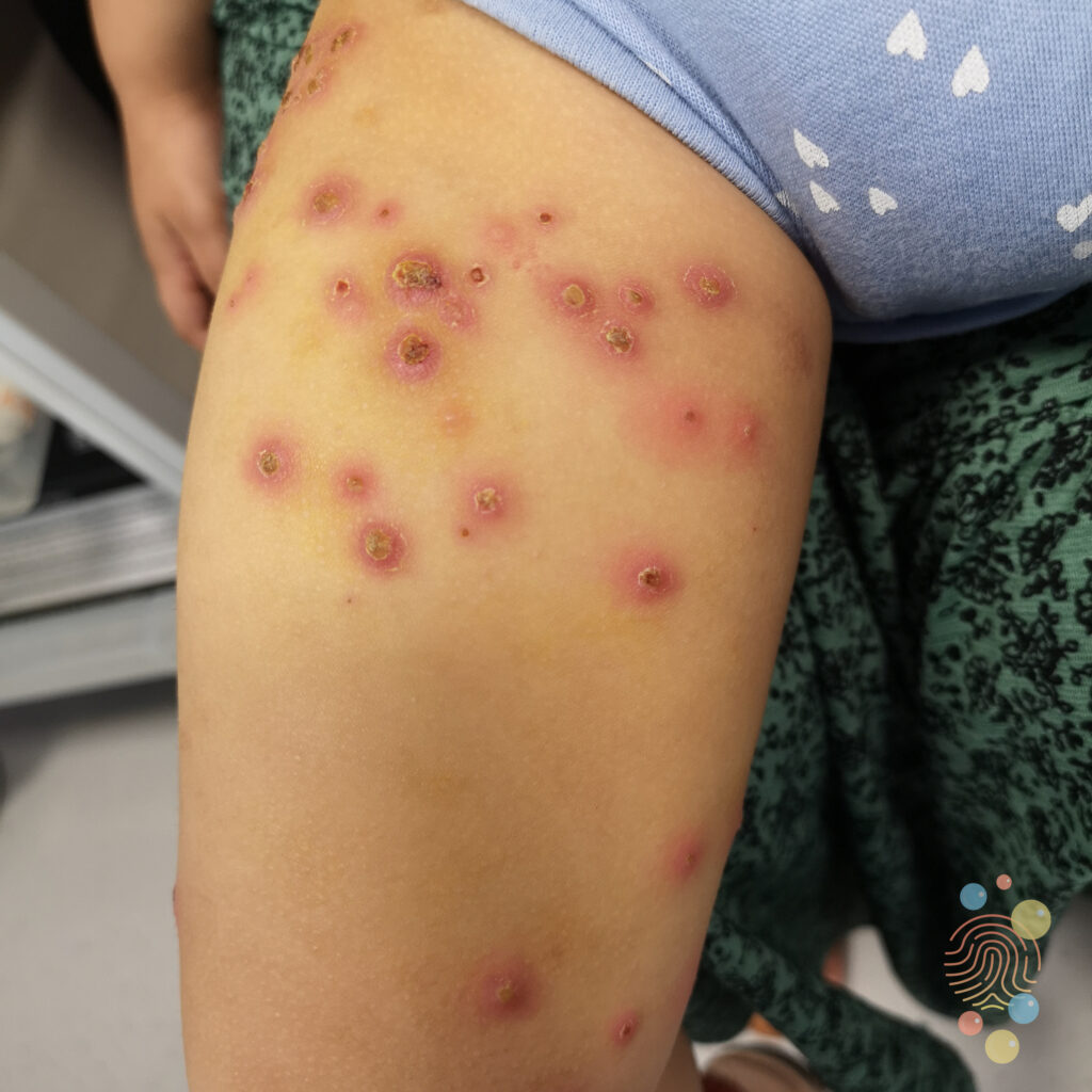 Chicken Pox