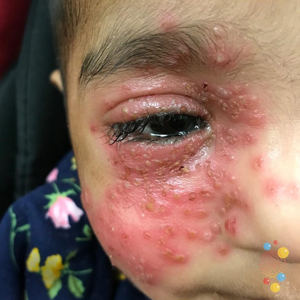 Eczema Herpeticum