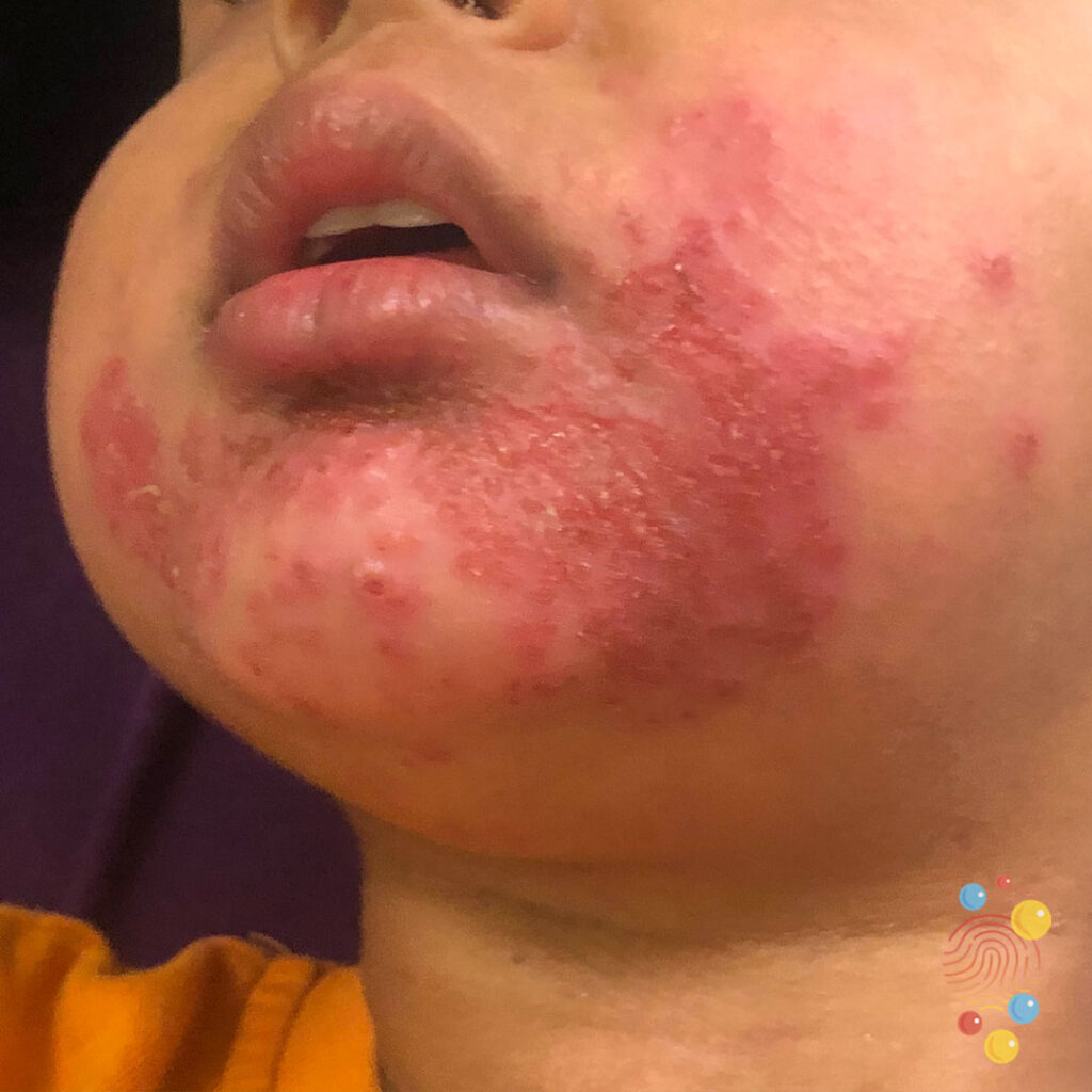 Eczema Herpeticum