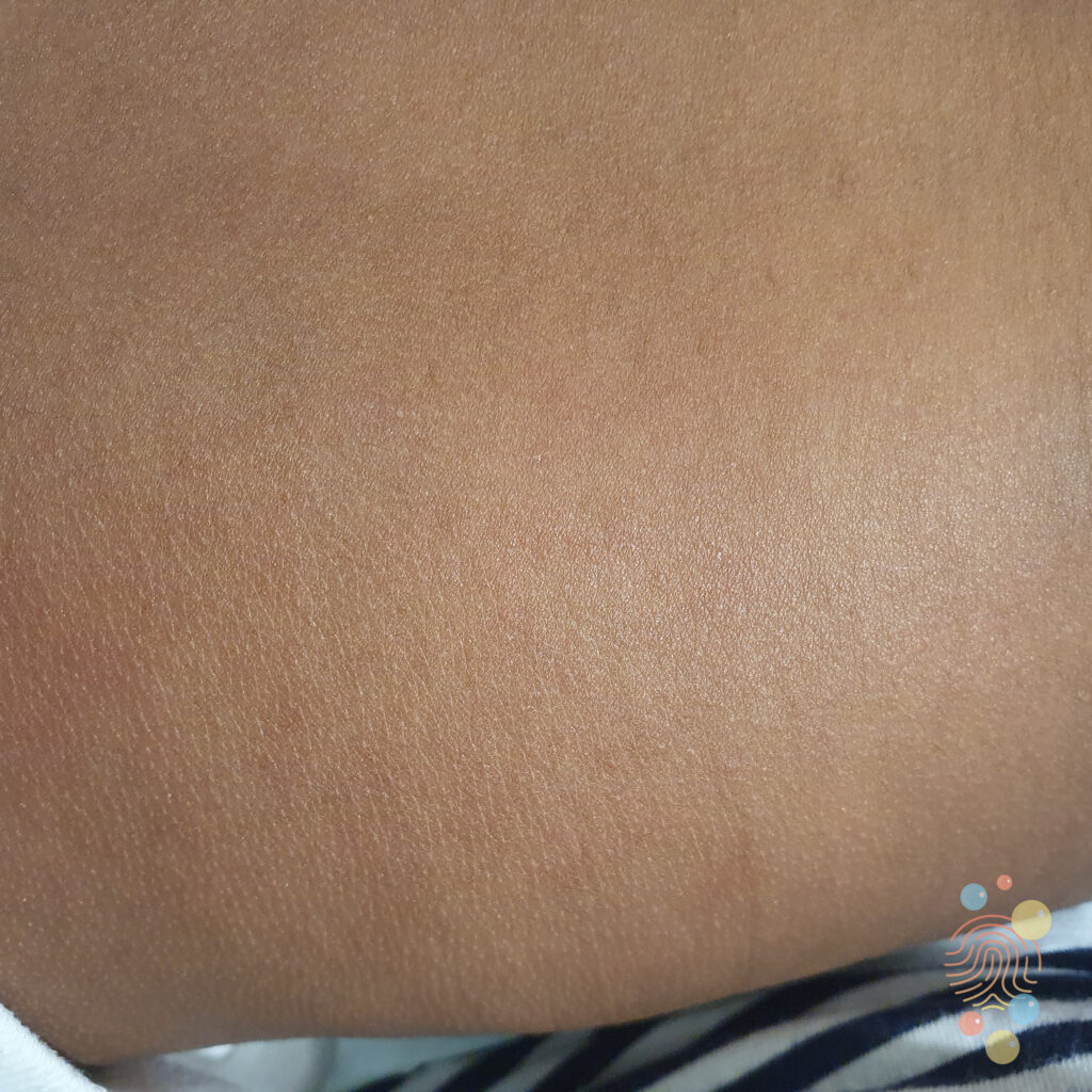 Roseola