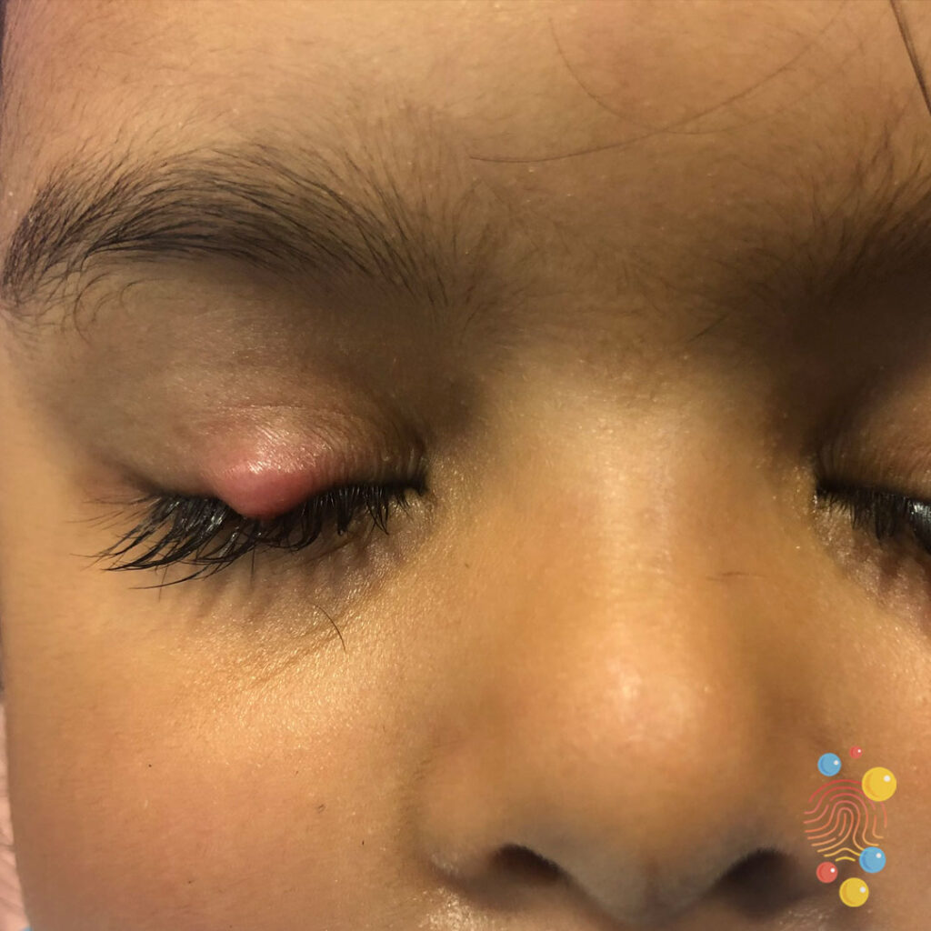 Chalazion