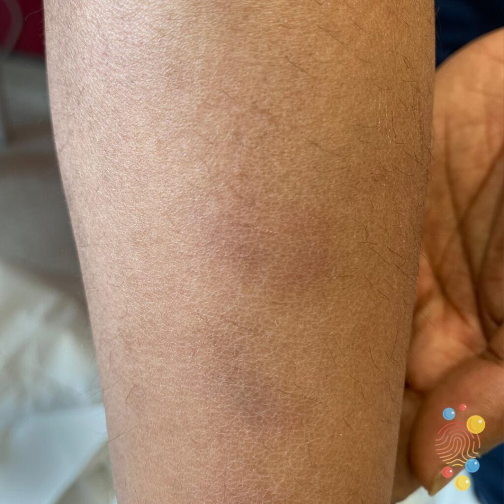 Erythema Nodosum