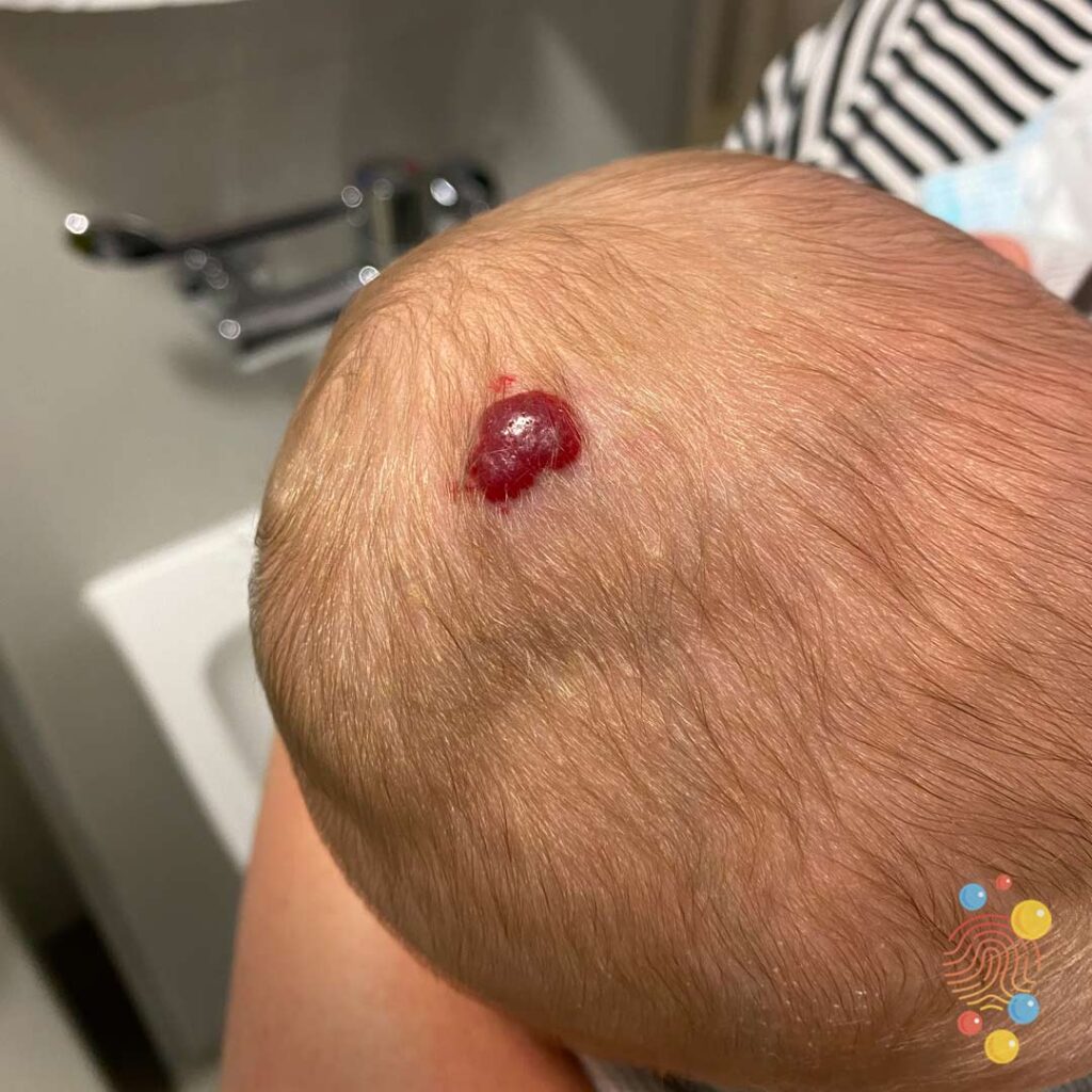 Superficial Infantile Haemangioma