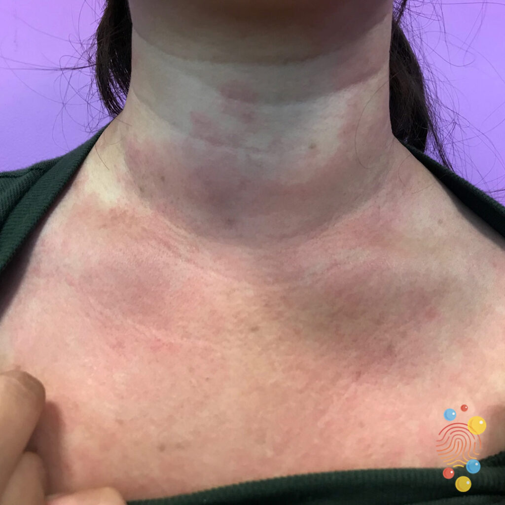 Urticaria