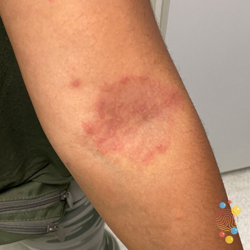 Eczema