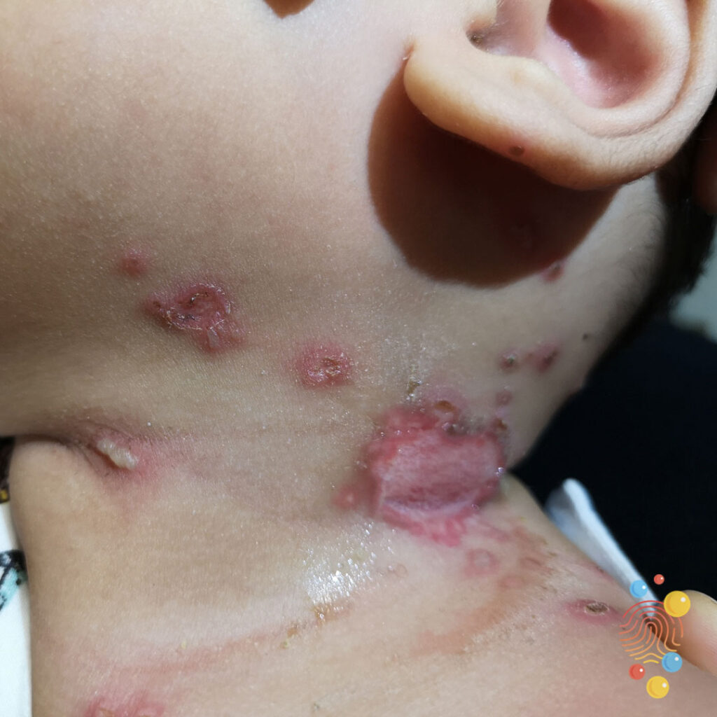 Herpes Simplex Virus