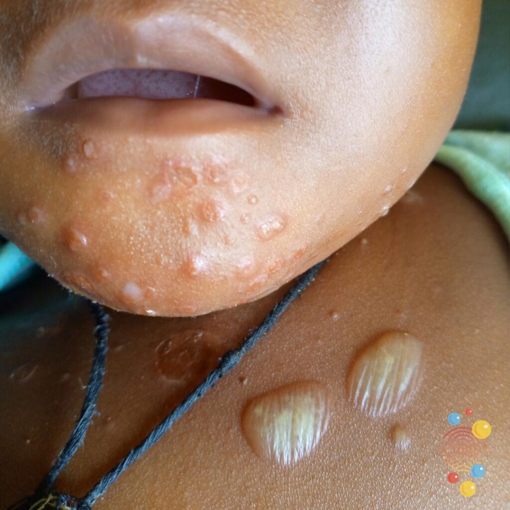Impetigo
