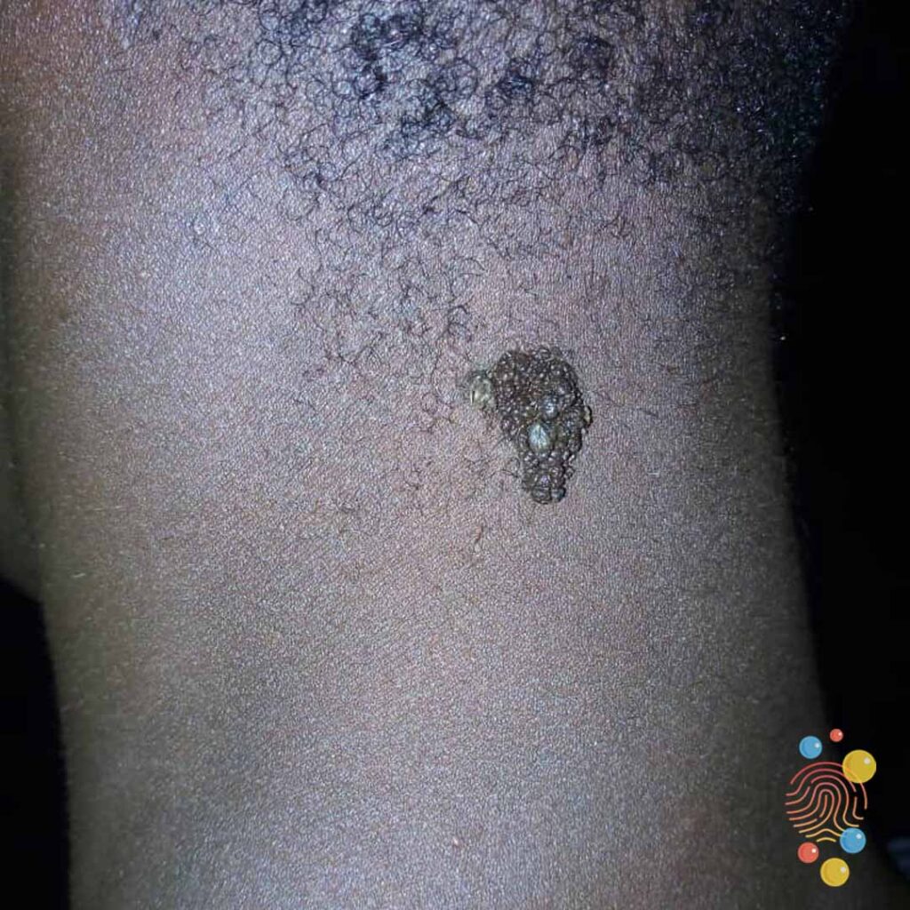 Epidermal Naevus