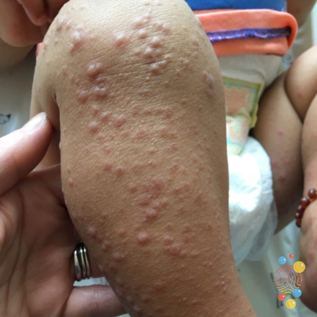 Gianotti-Crosti Syndrome