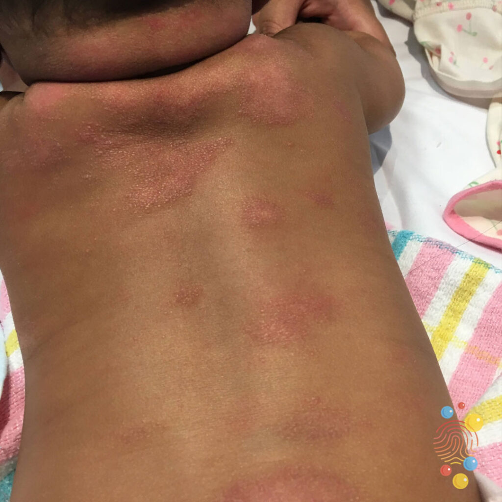 Eczema