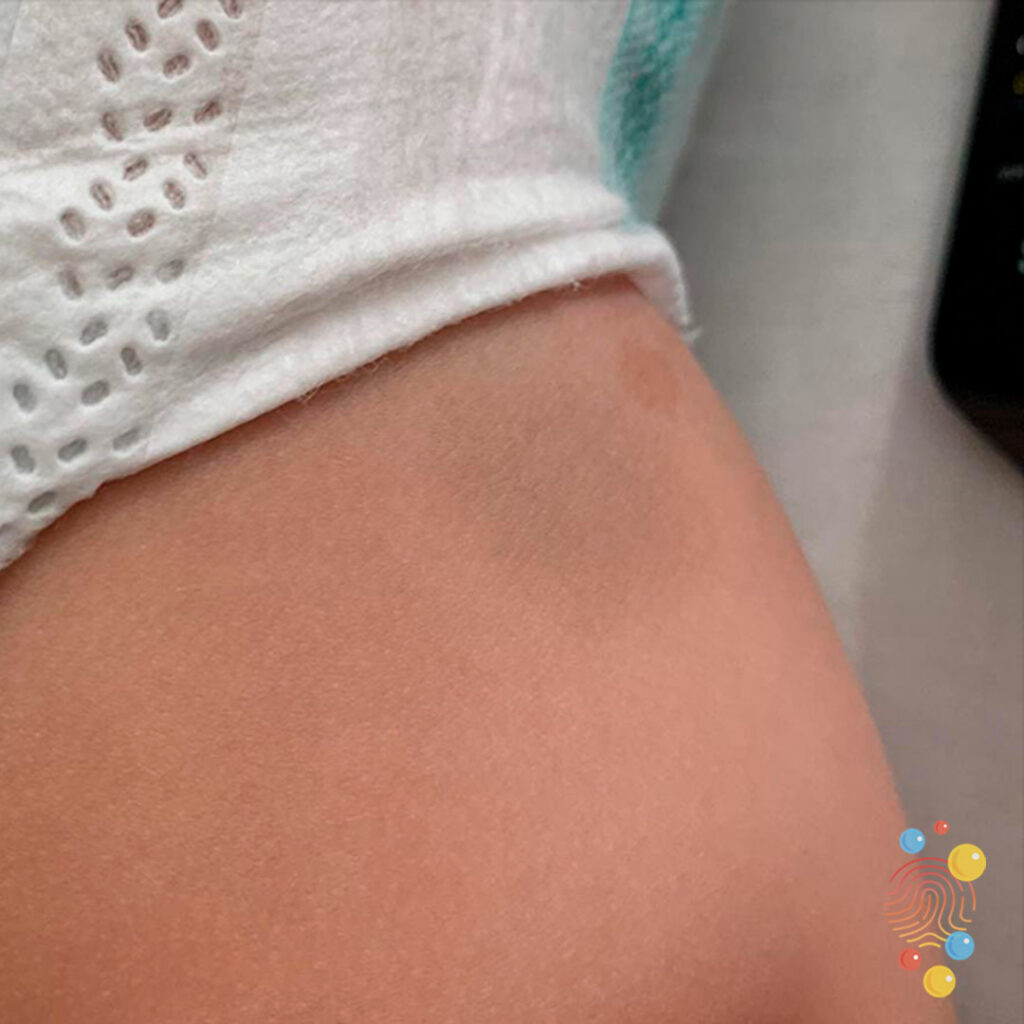 Dermal Melanocytosis