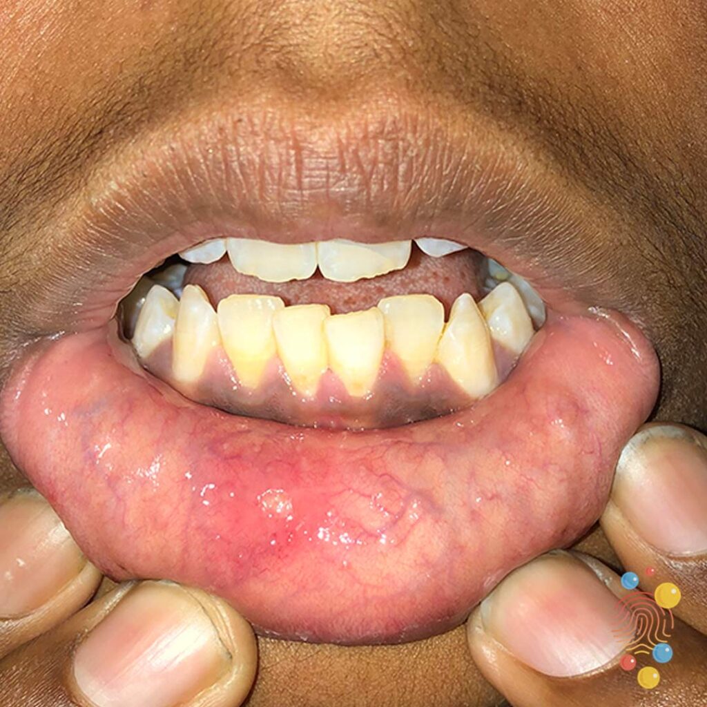 Aphthous Ulcer