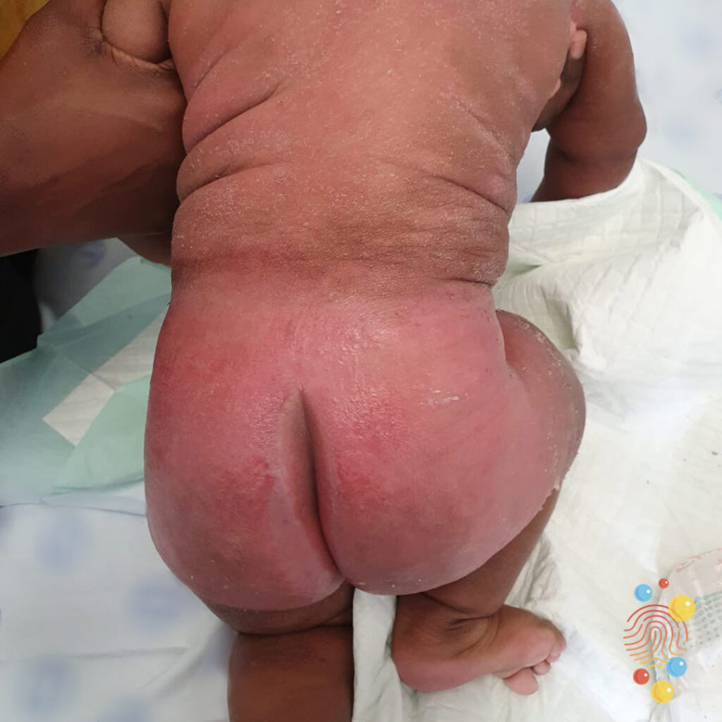 Irritant Dermatitis