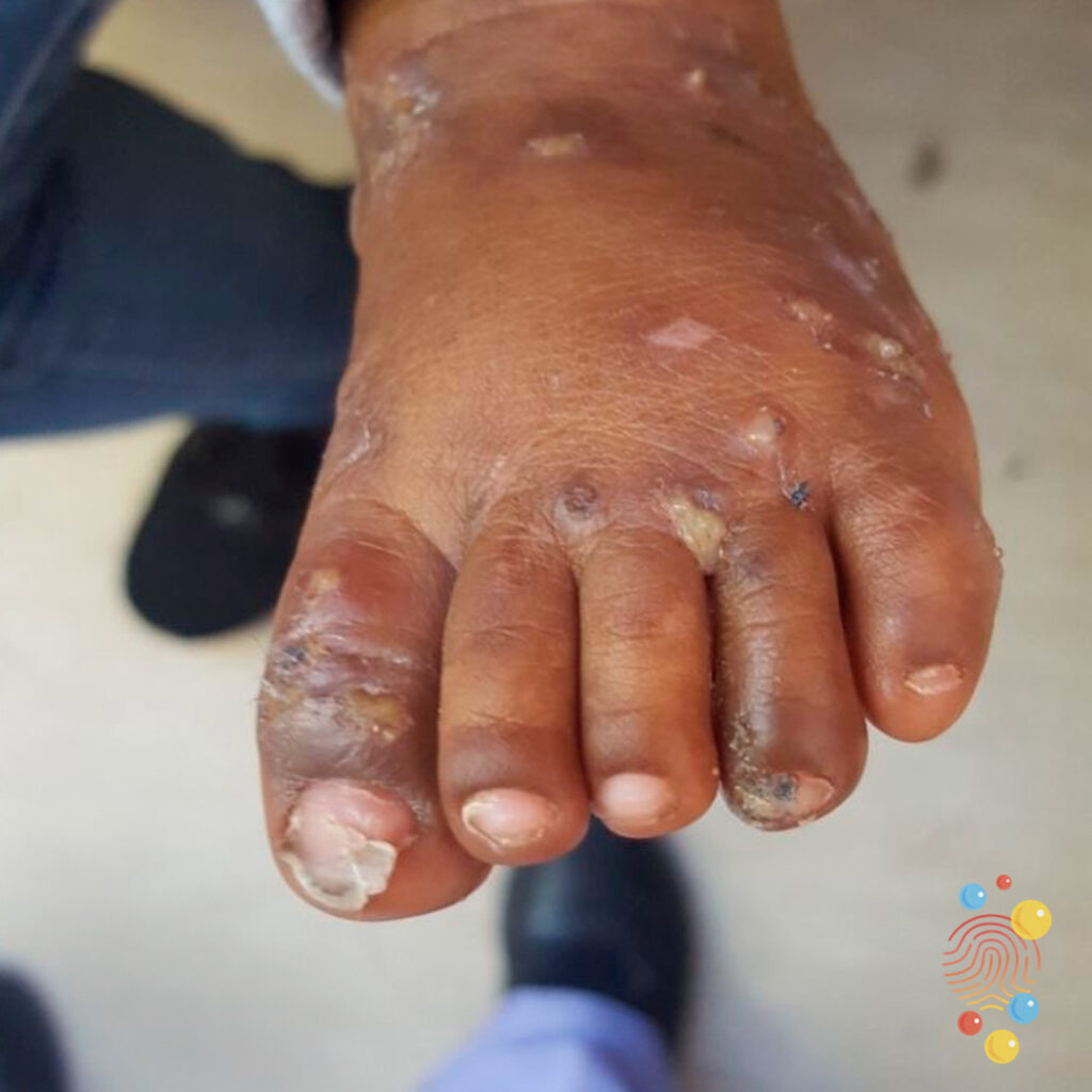Scabies