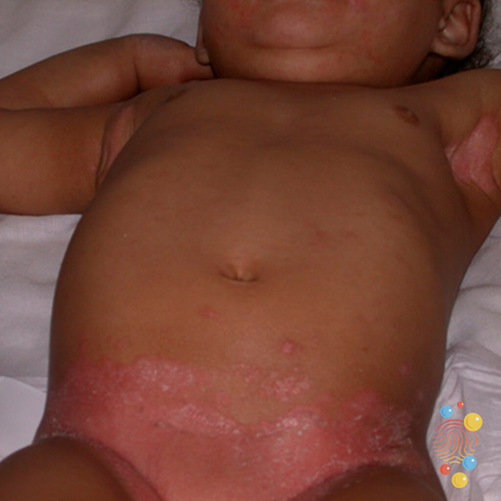 Intertrigo (Due To Candida)