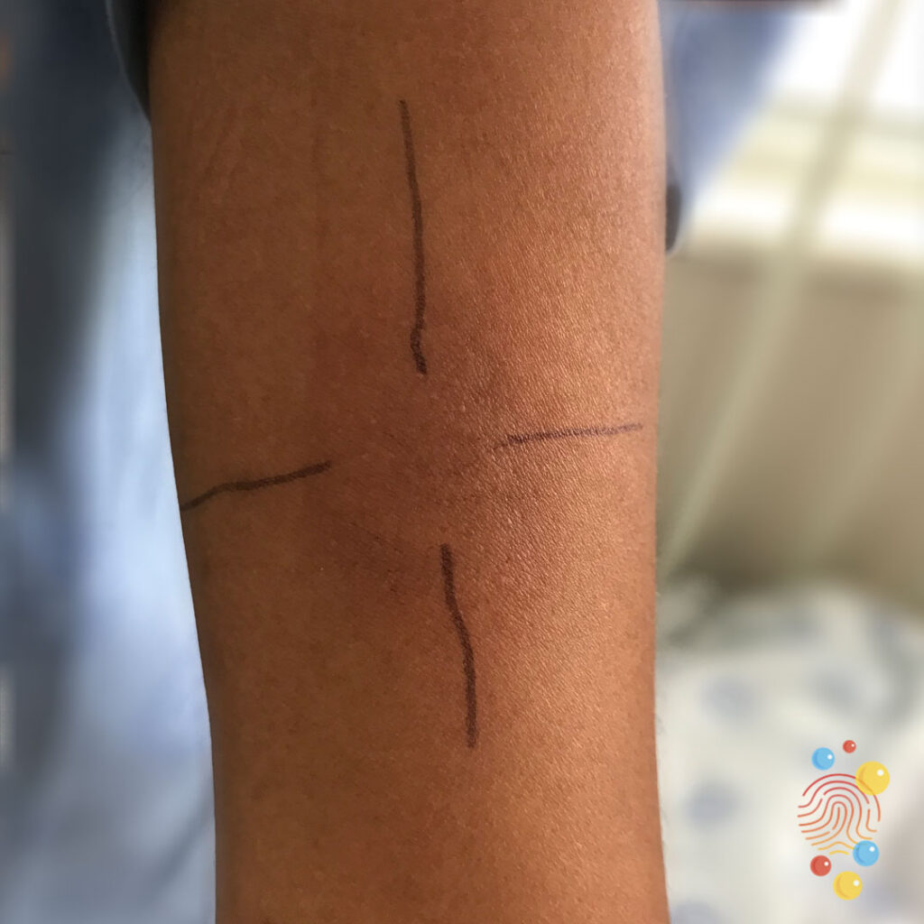 Positive Mantoux (Indurated)