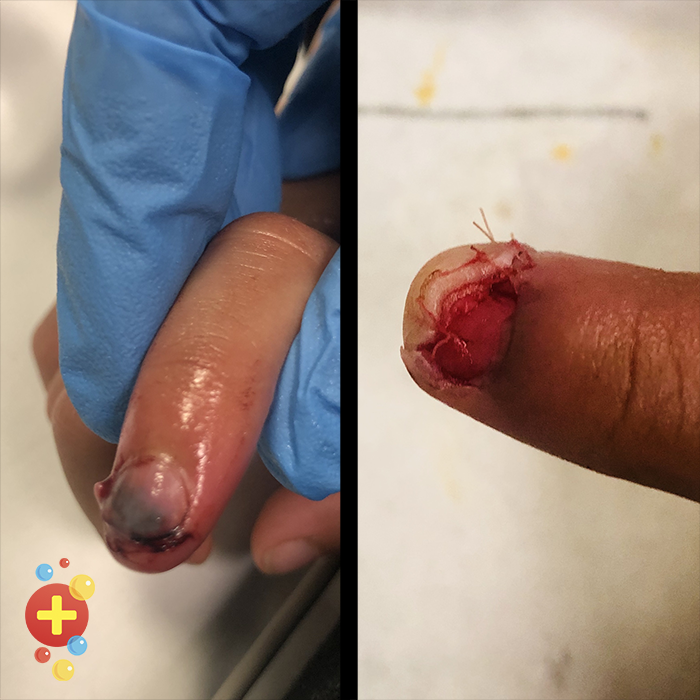 Nailbed Repair