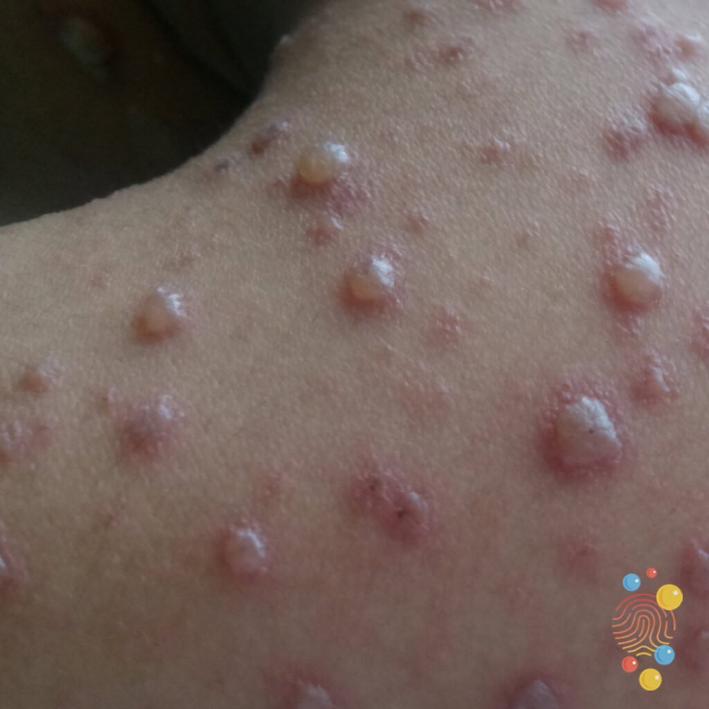 Chicken Pox