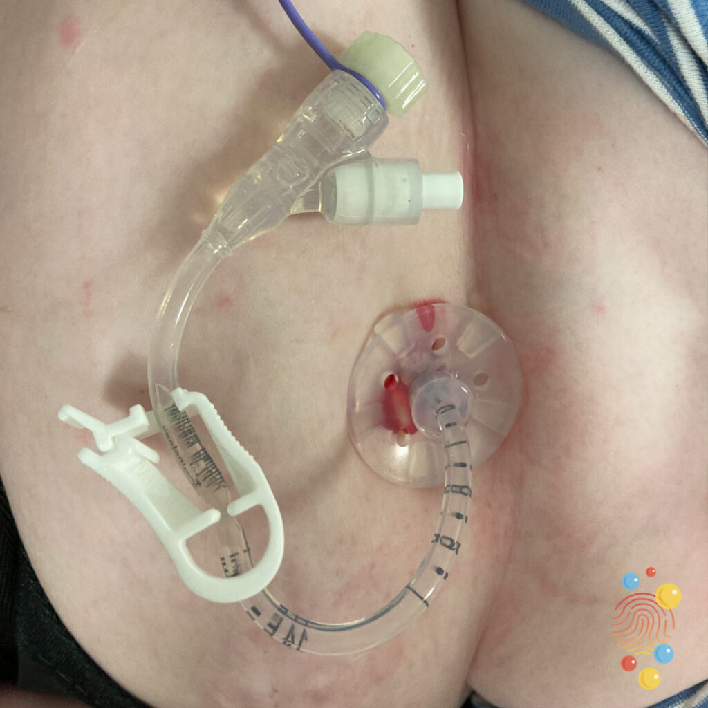 Mic-G Balloon Gastrostomy