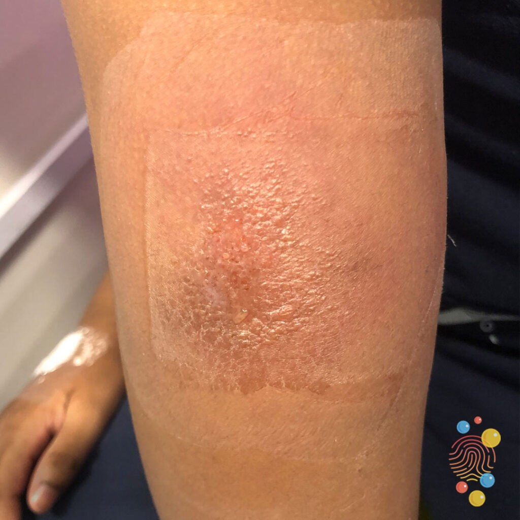 Cellulitis