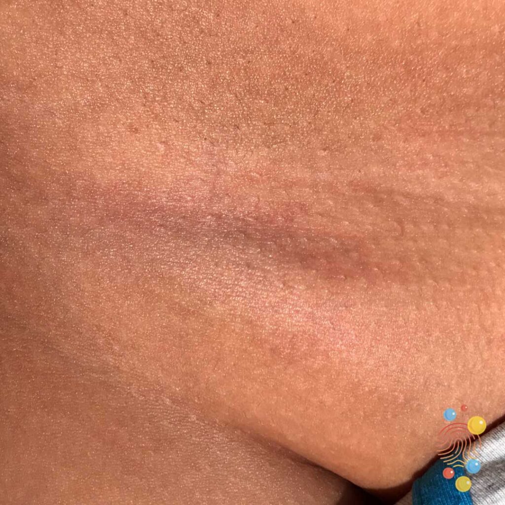 Groin Haematoma