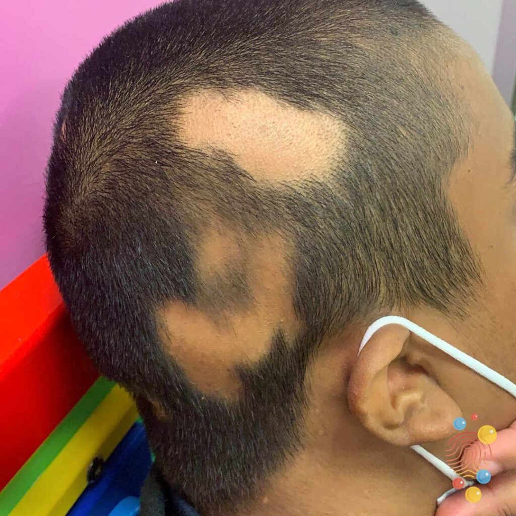 Alopecia