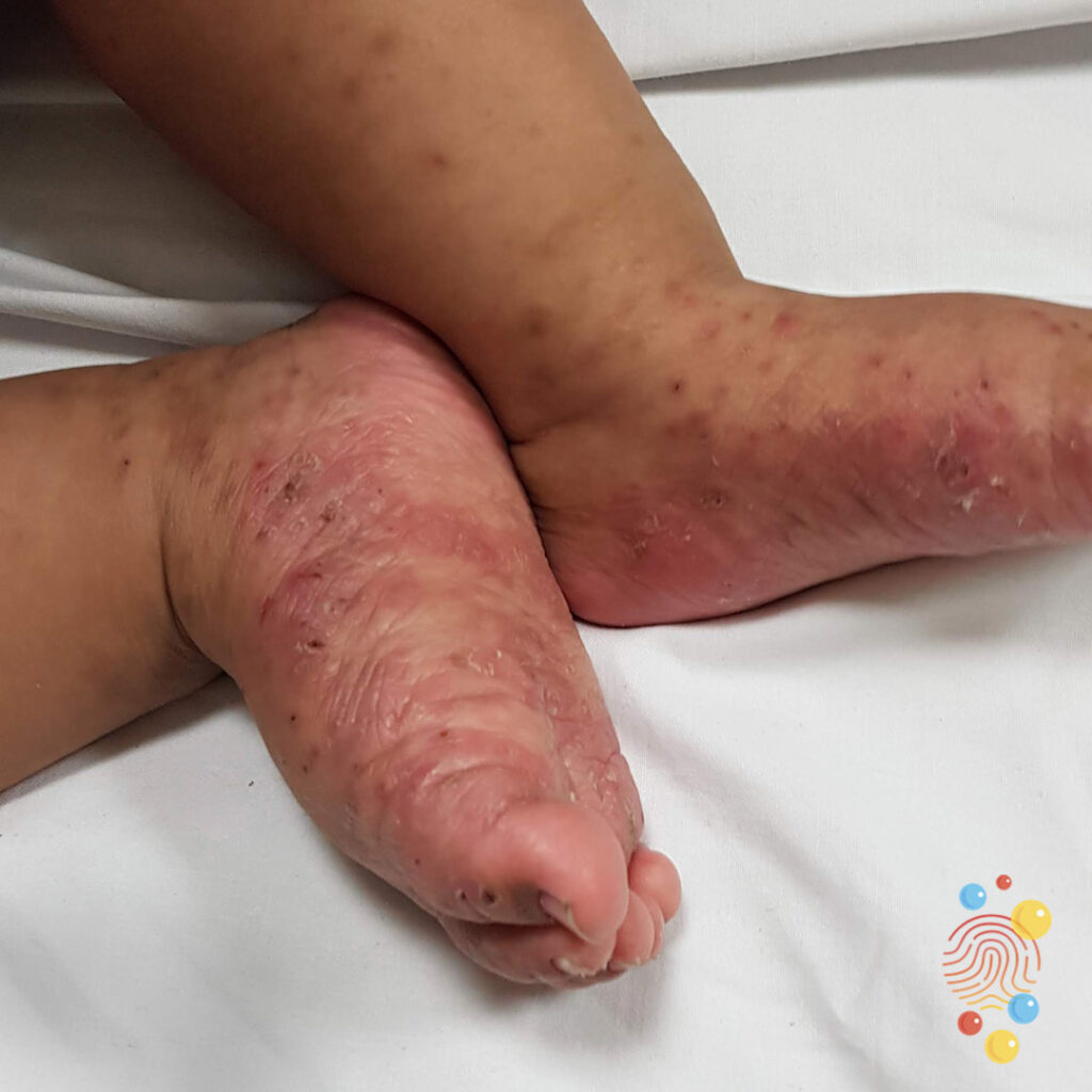Scabies