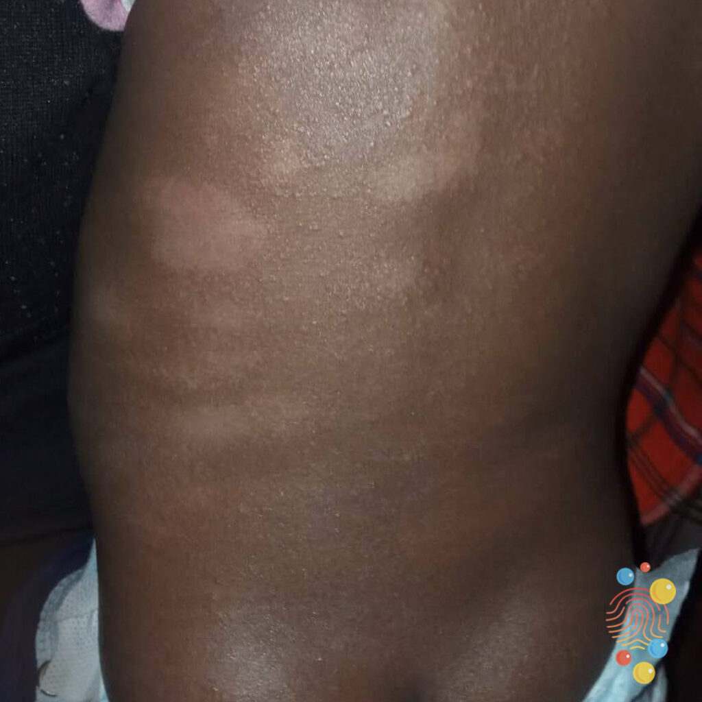 Pityriasis Alba