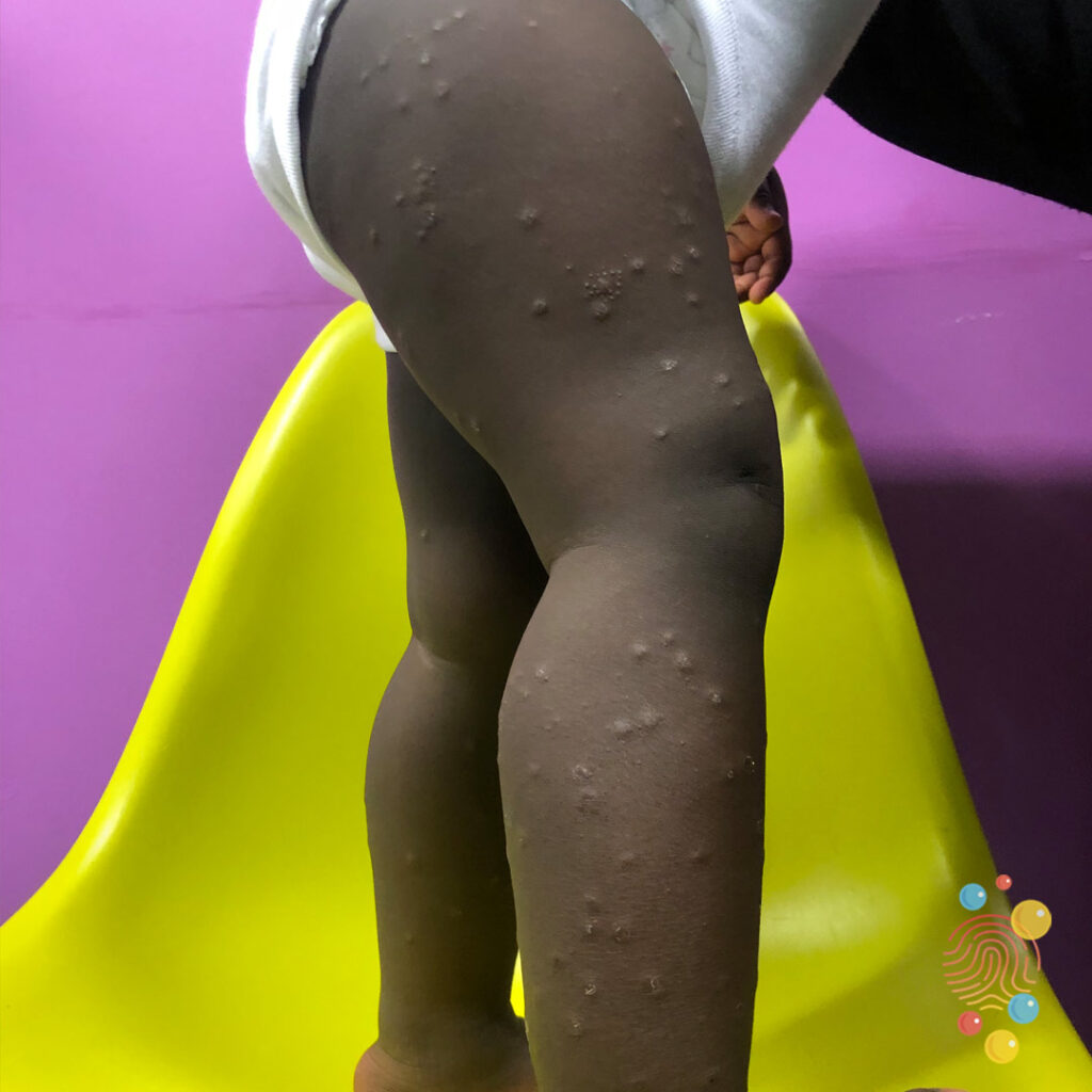 Gianotti-Crosti Syndrome
