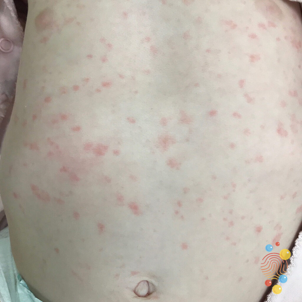 Roseola