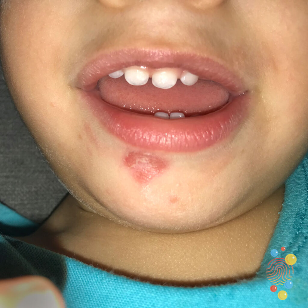 Impetigo