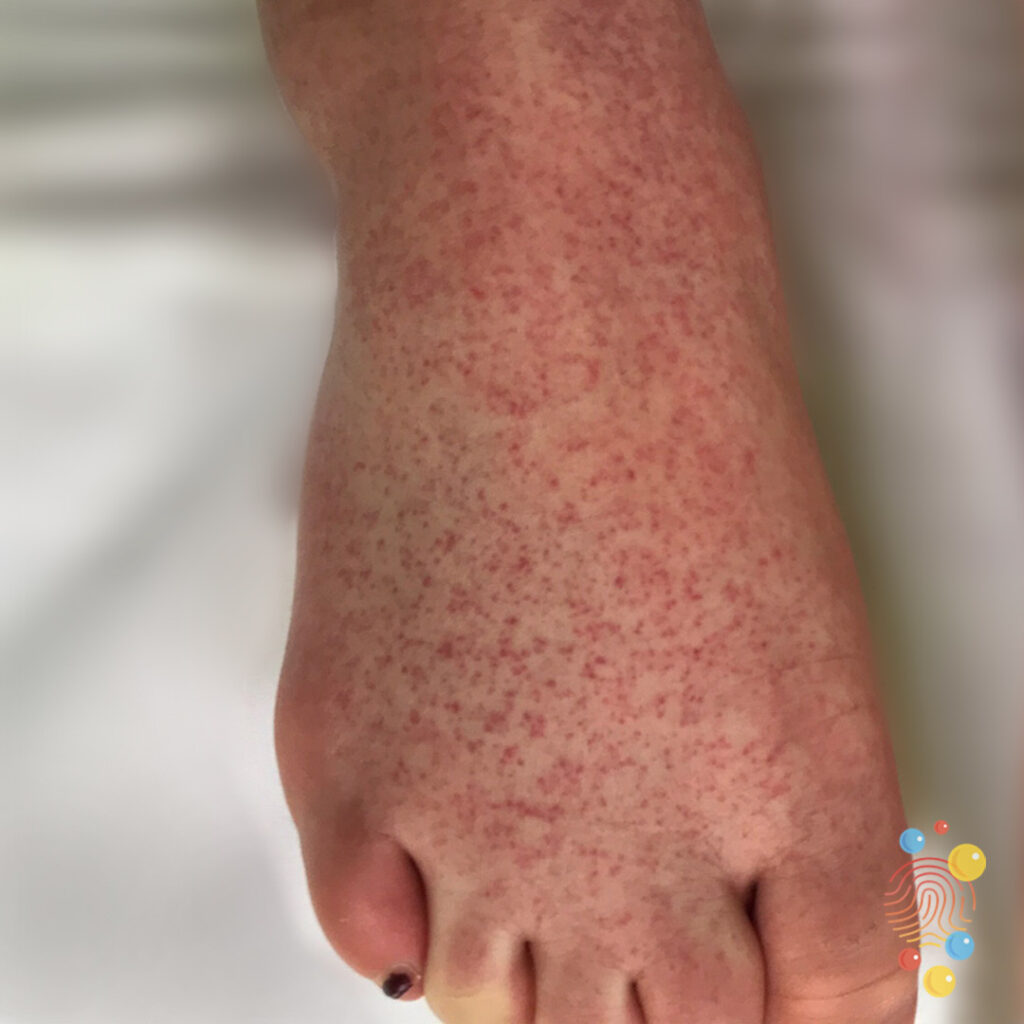 Vasculitis