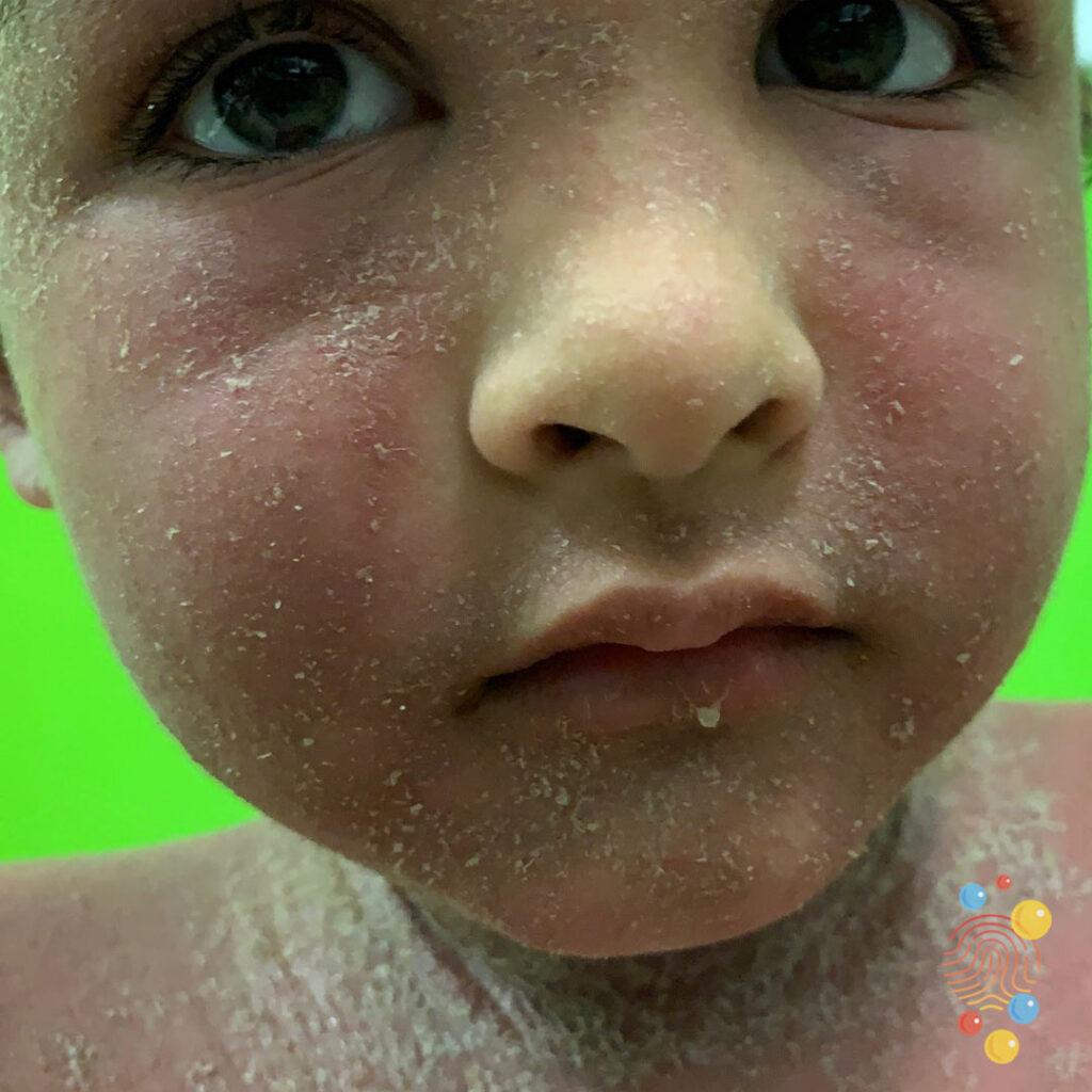Eczema With Secondary Impetiginisation