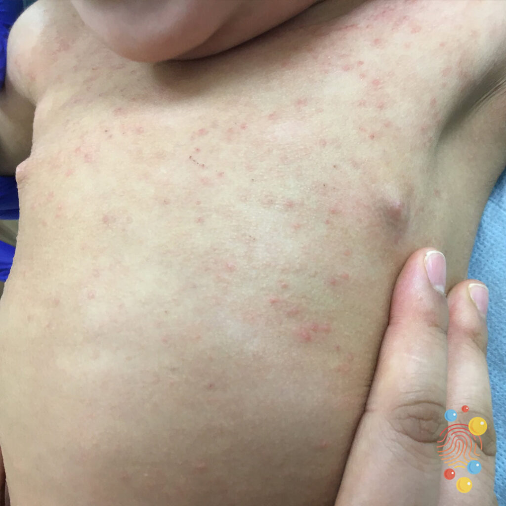 Eczema
