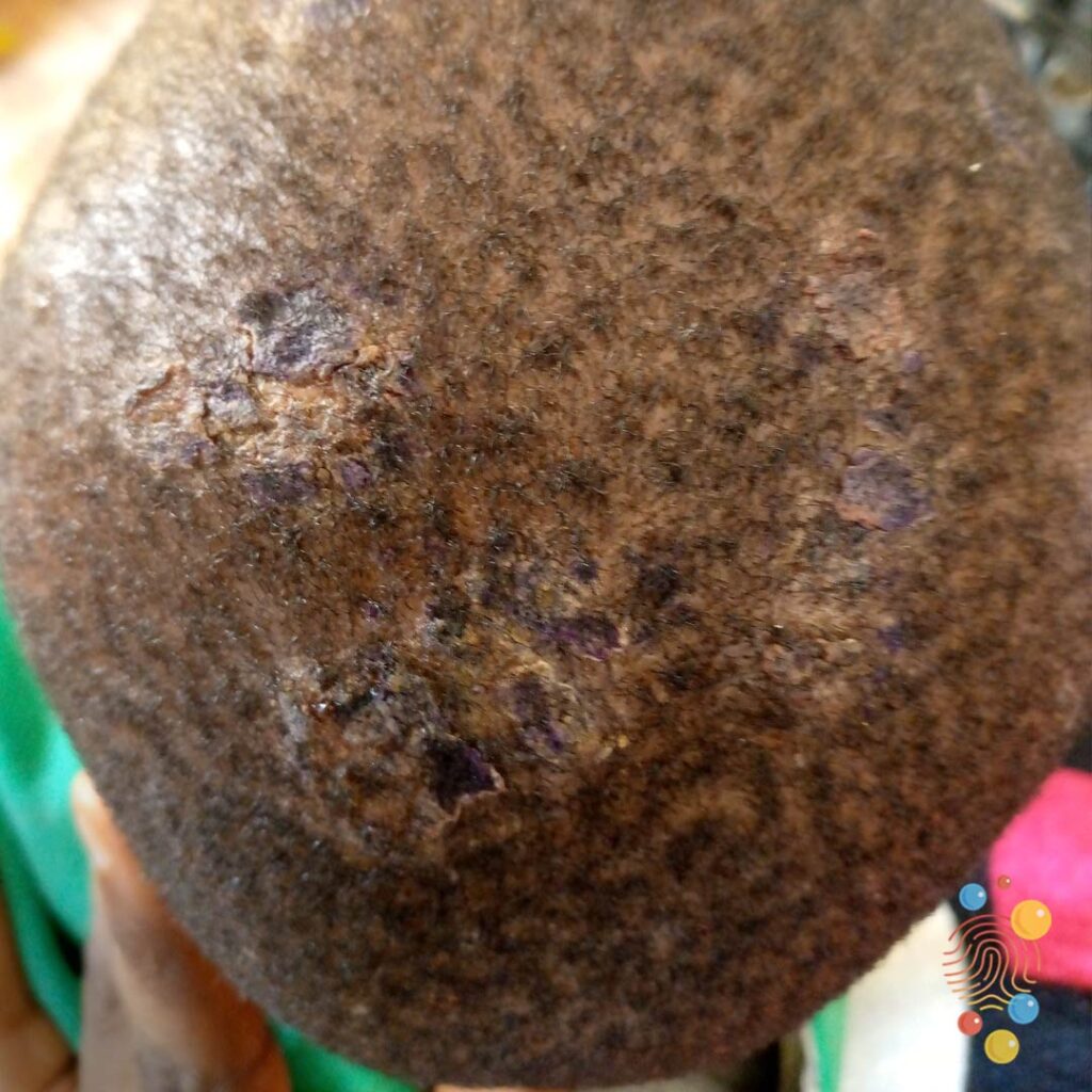 Kerion With Secondary Impetiginisation