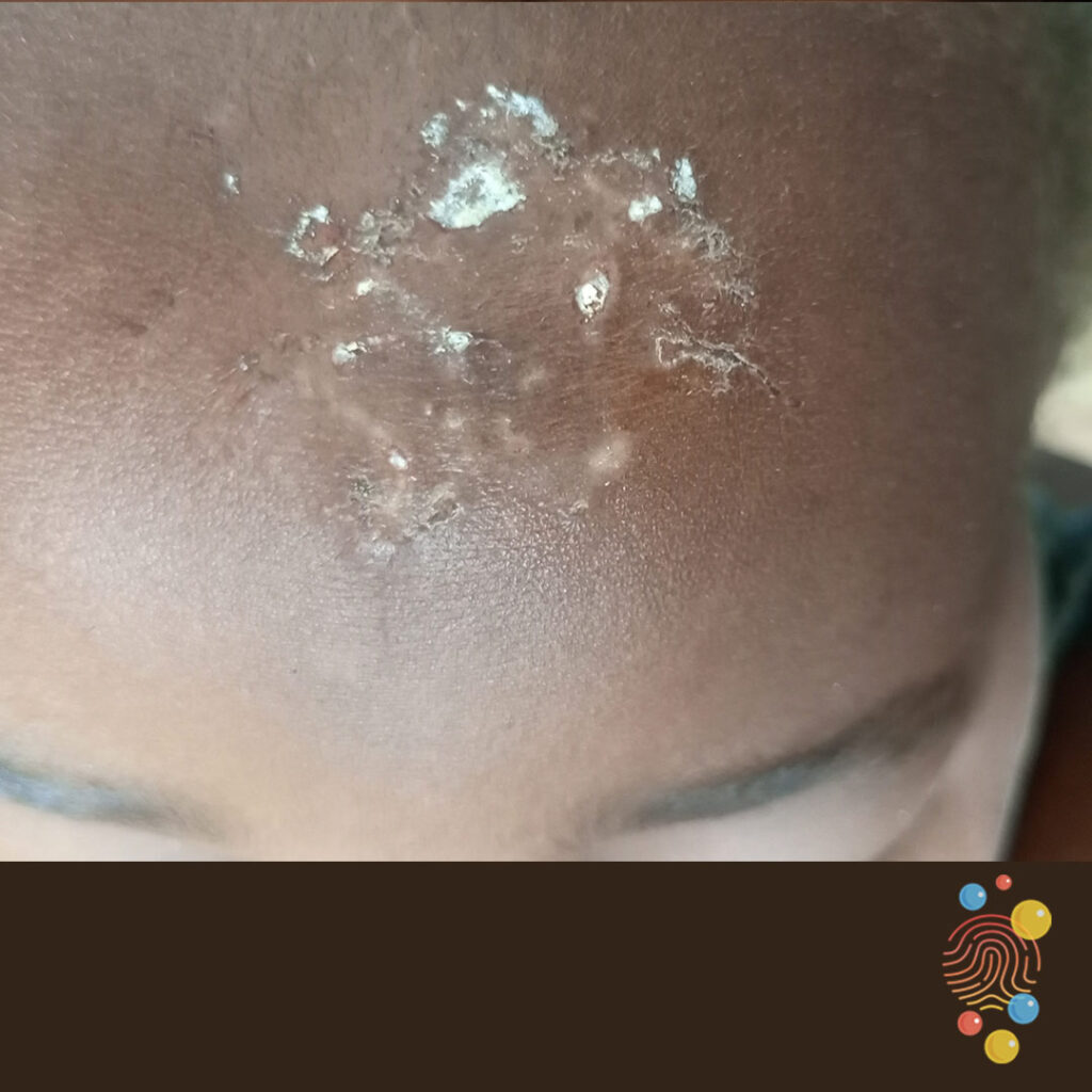 Tinea Capitis