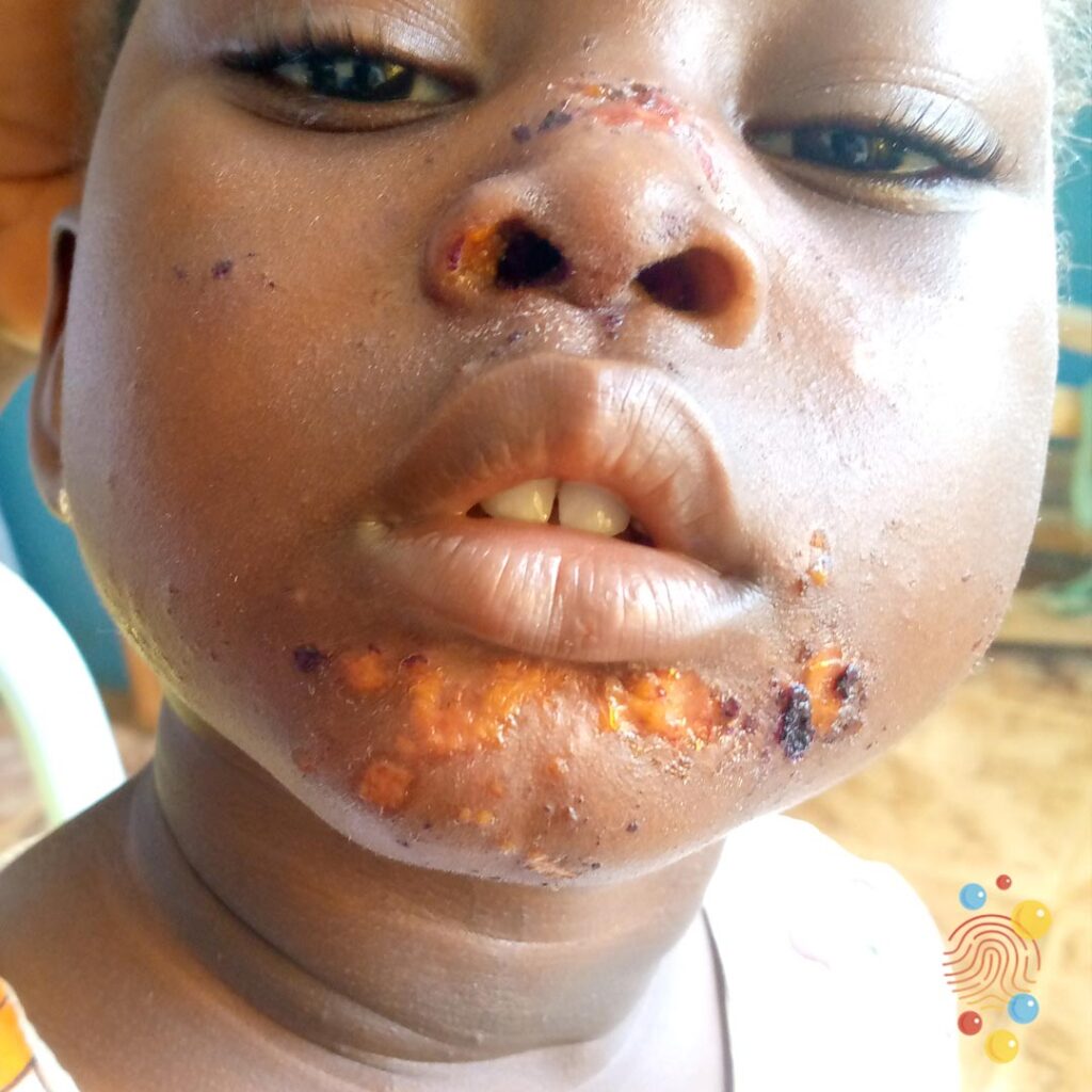 Impetigo