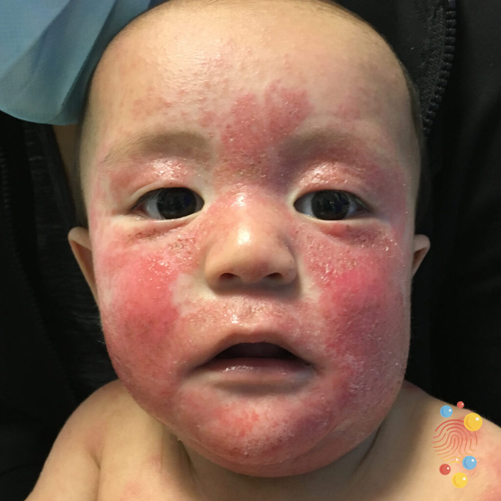 Eczema