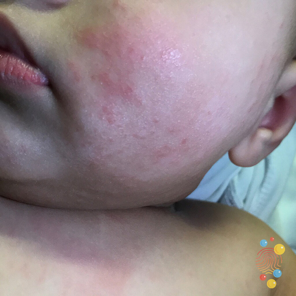 Infantile Acne