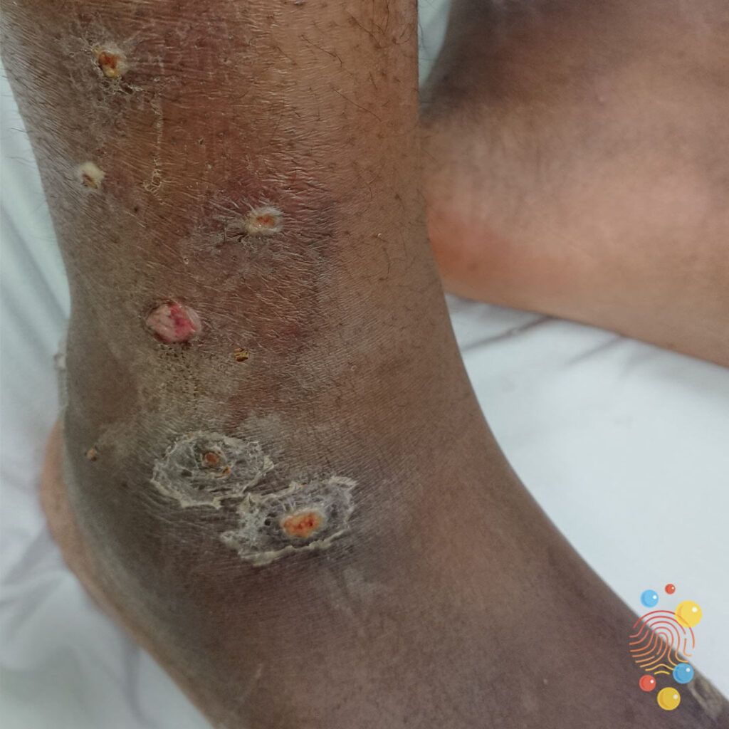 Bullous Impetigo