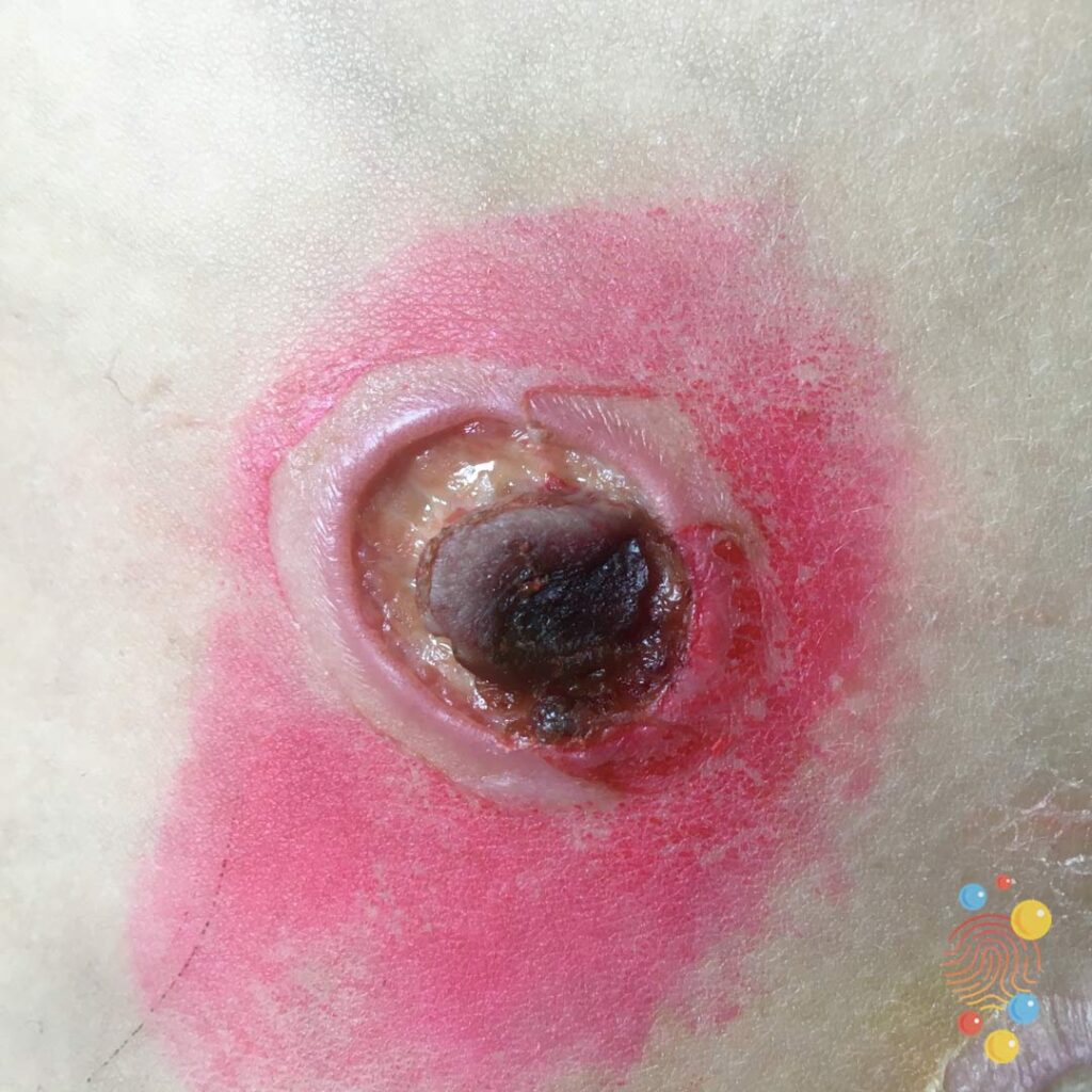 Umbilicus Ulceration