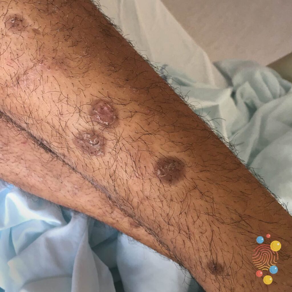 Nummular Eczema