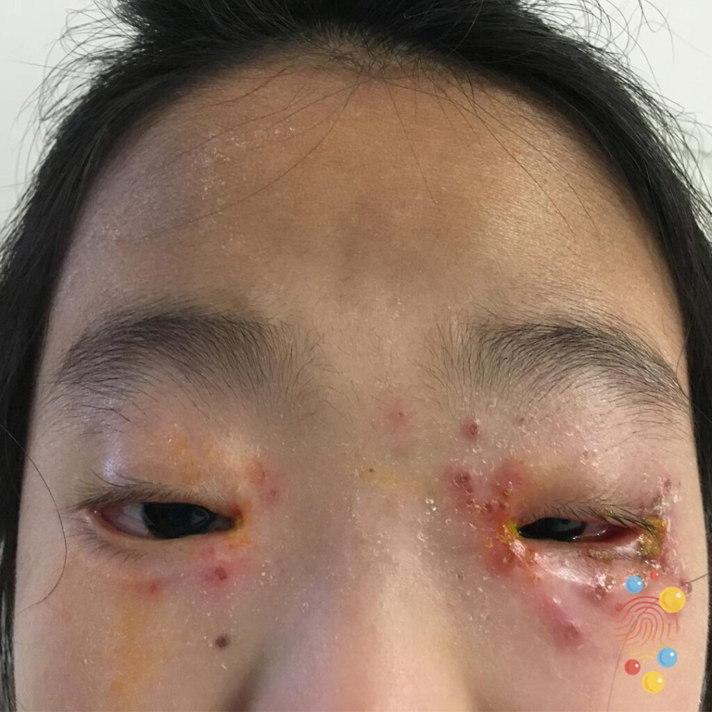 Eczema Herpectium