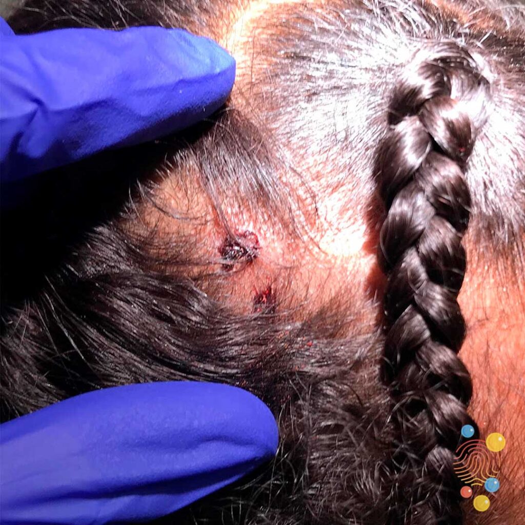 Epidermoid Cyst