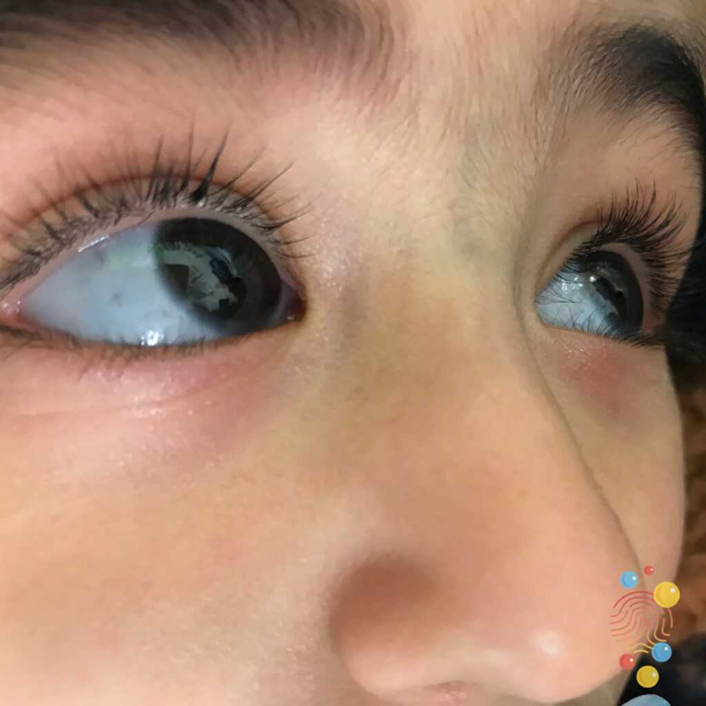 Blue Sclerae In Osteogenesis Imperfecta