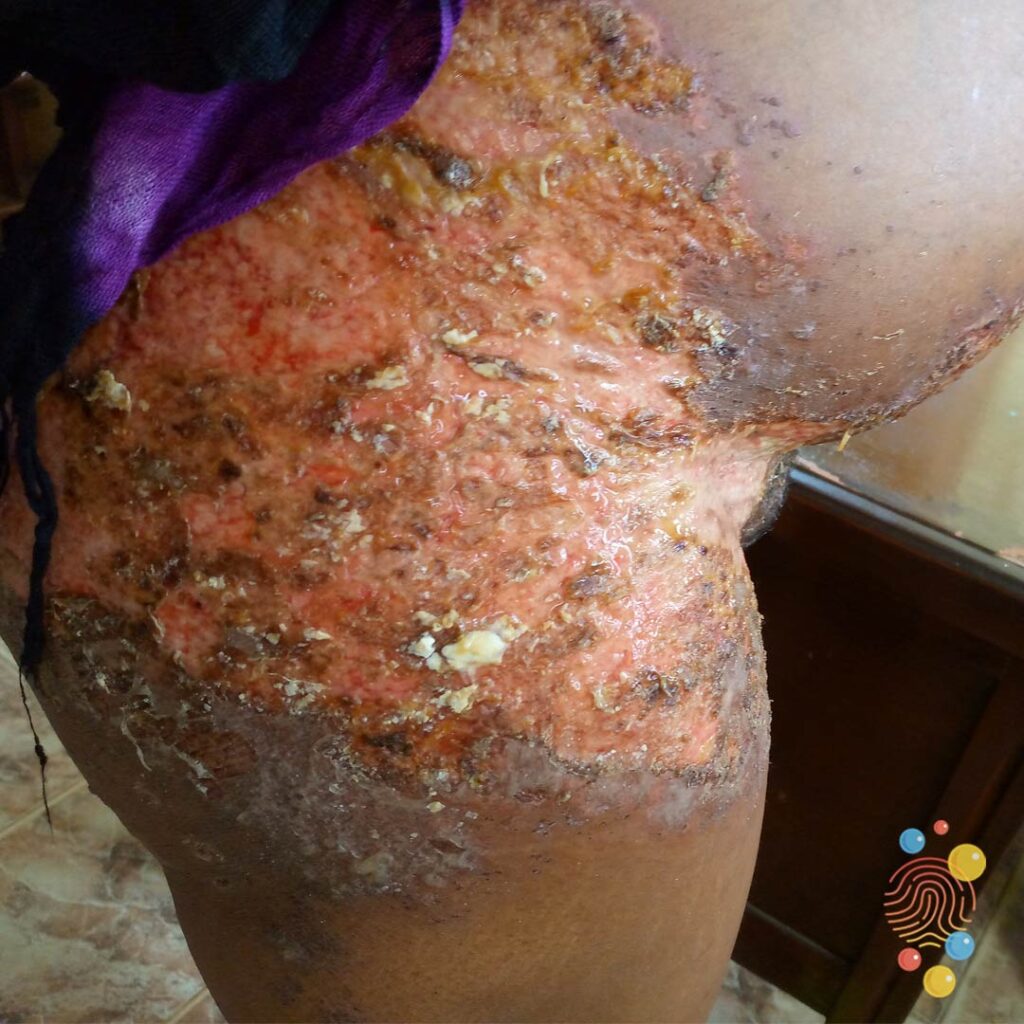 Herpes Zoster