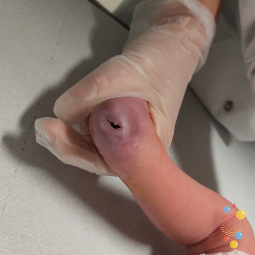 Abscess