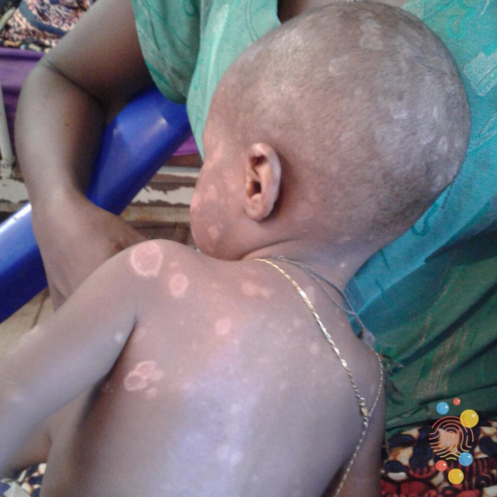 Tinea Corporis And Tinea Capitis