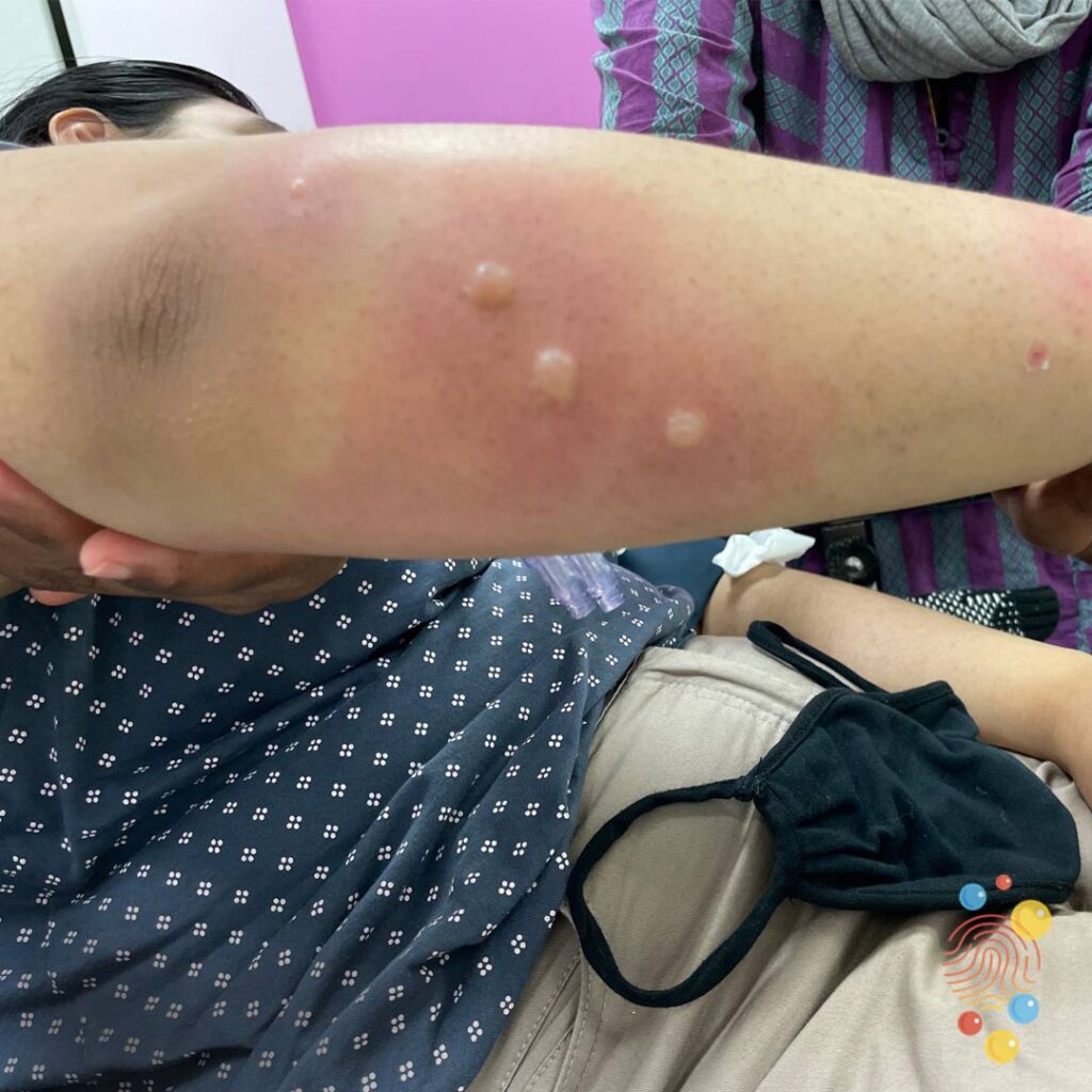 Bullous insect bite reaction